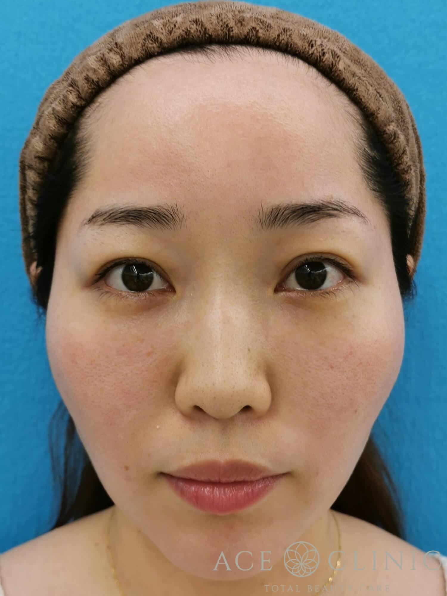 ヒアルロン酸注入(鼻・ほうれい線) 施術後 正面