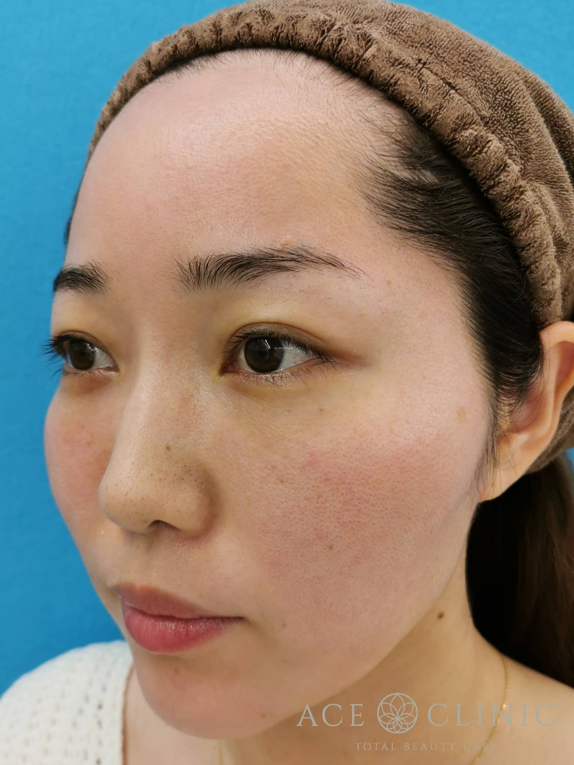 ヒアルロン酸注入（鼻・ほうれい線）　施術後　斜め