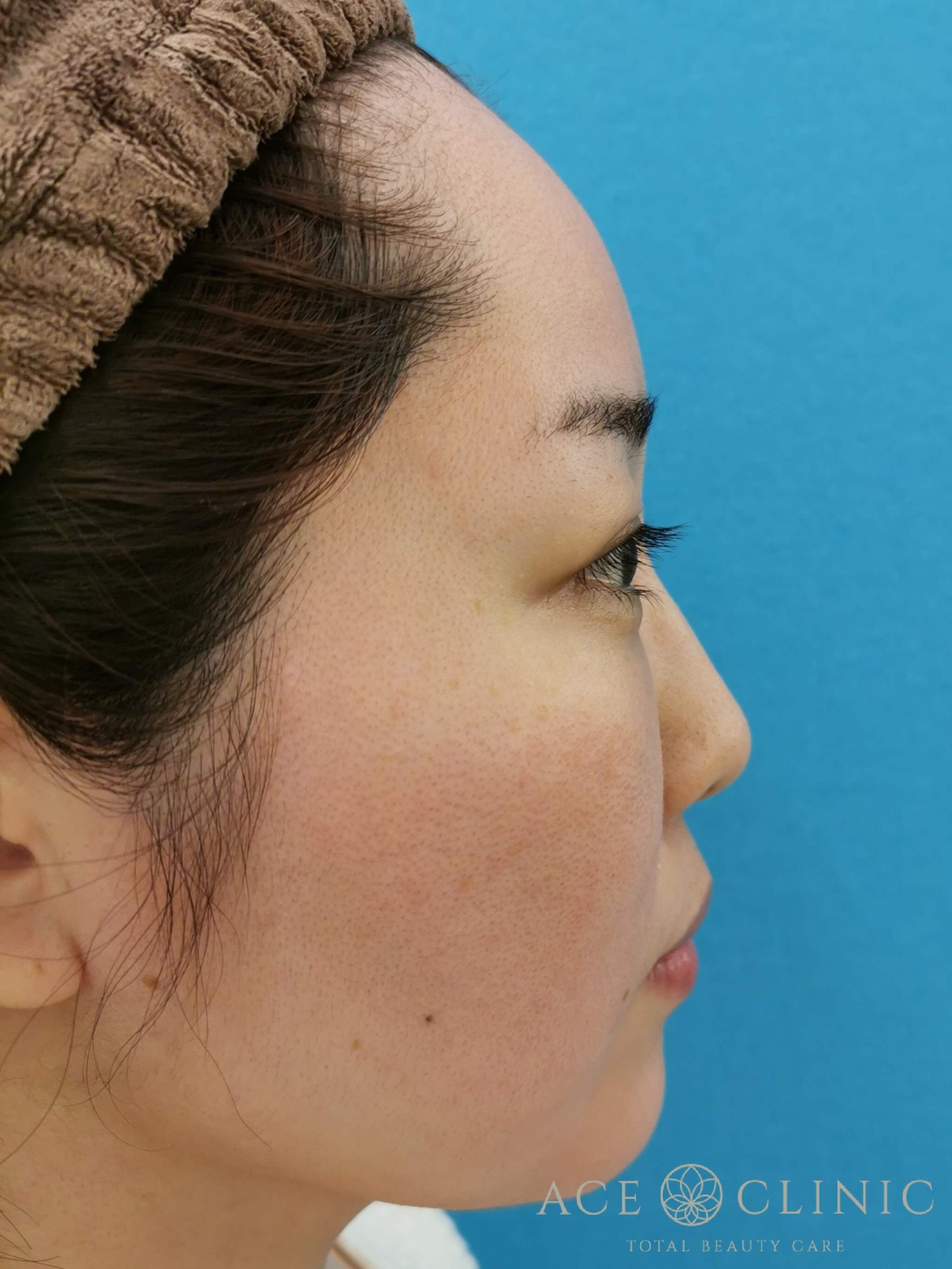 ヒアルロン酸注入（鼻・ほうれい線）　施術後　横