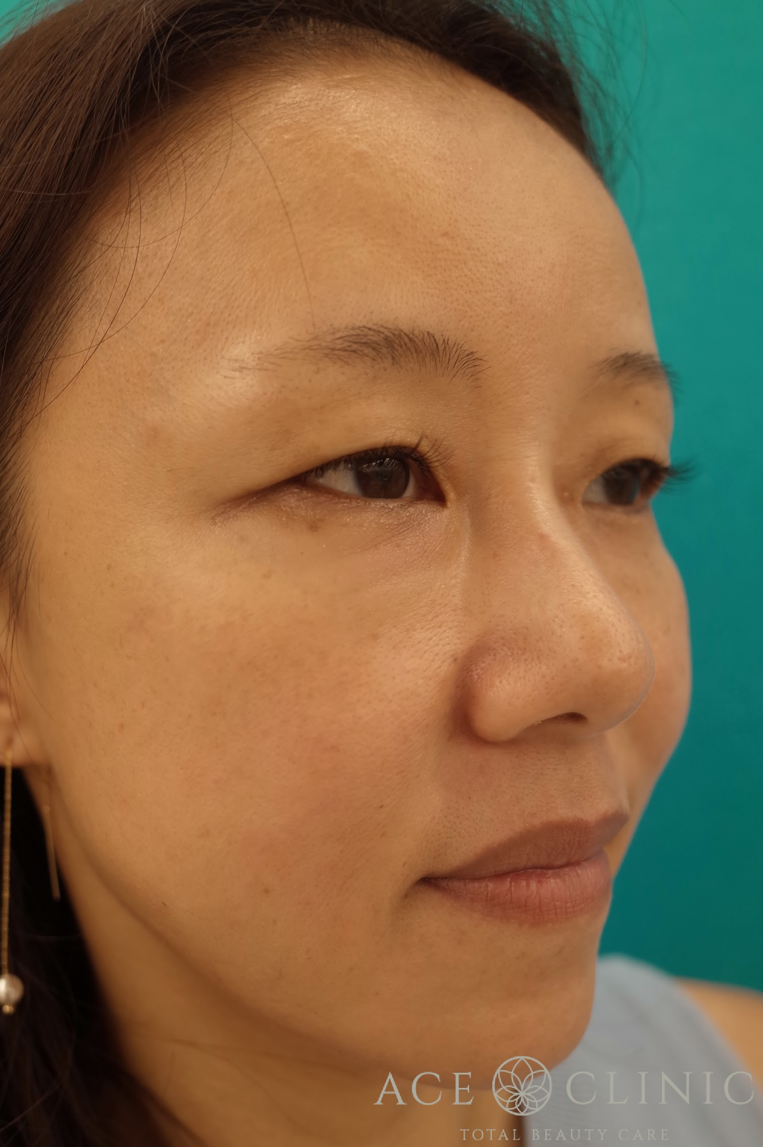 ヒアルロン酸リフト　施術後　右斜め