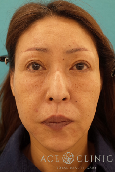 ヒアルロン酸注入_こめかみ・額・ほうれい線・マリオネットライン・頬・顎への注入_50代女性症例【エースクリニック】名古屋院・大阪梅田院