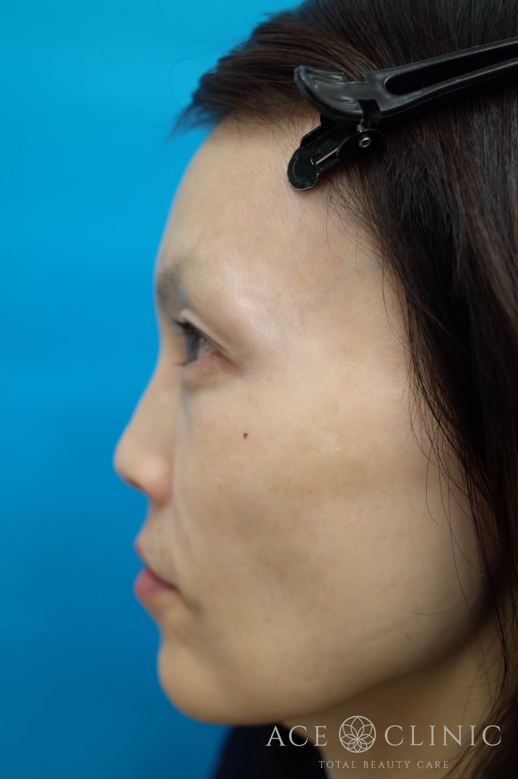 ヒアルロン酸注入（こめかみ・頬）　施術前　左横