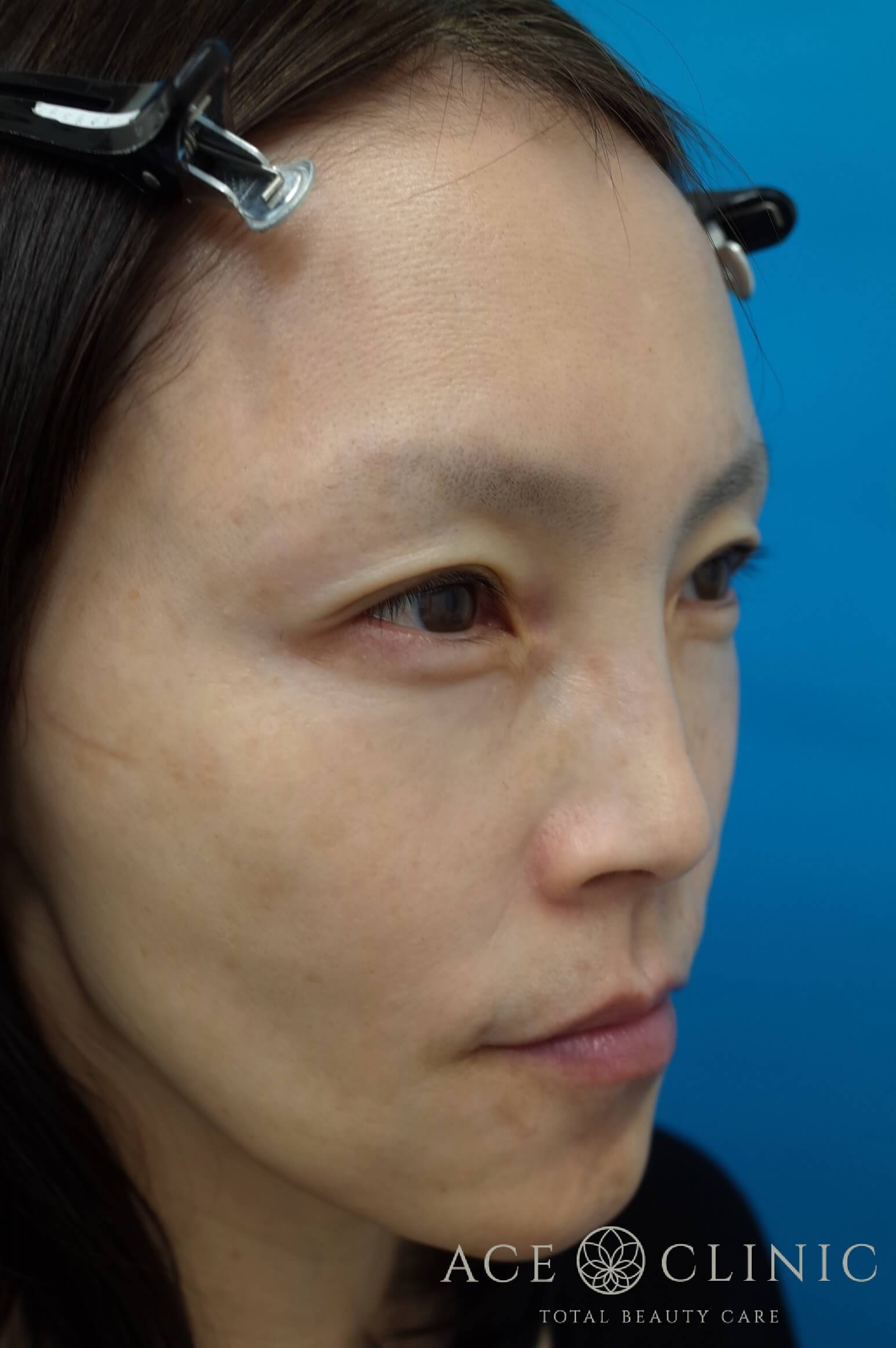 ヒアルロン酸注入（こめかみ・頬）　施術後　右斜め