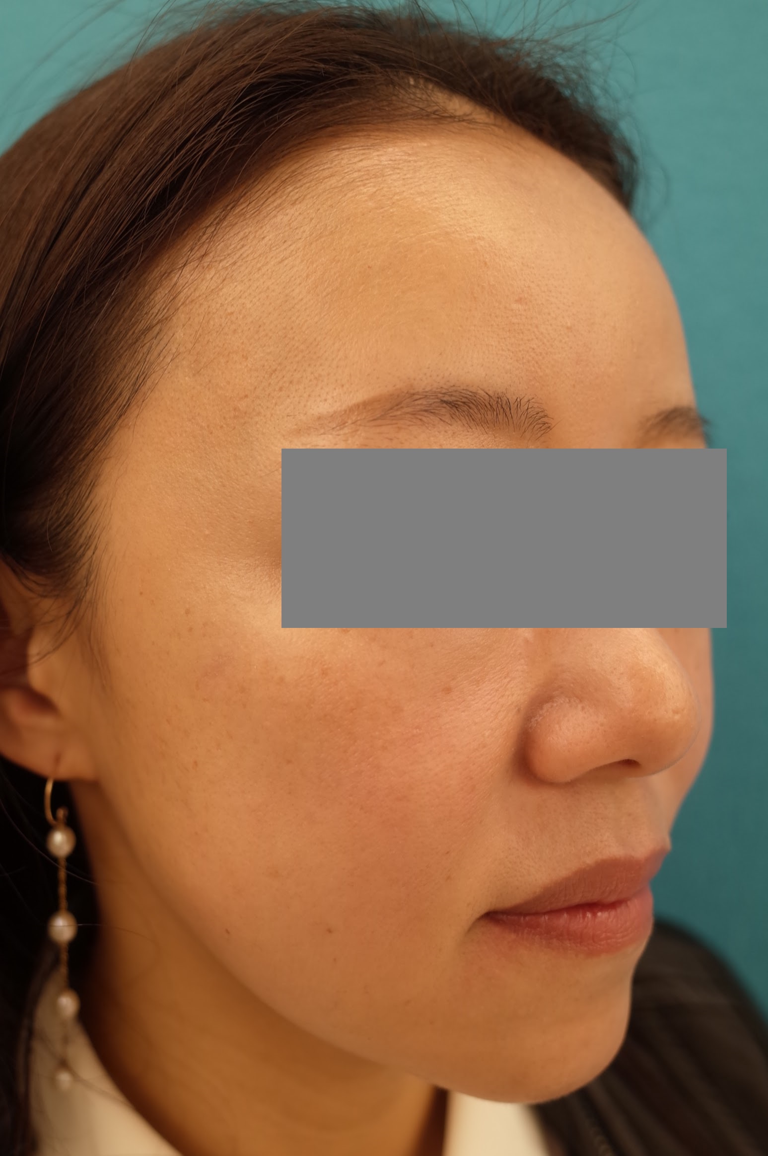 エラボトックス注射 施術後