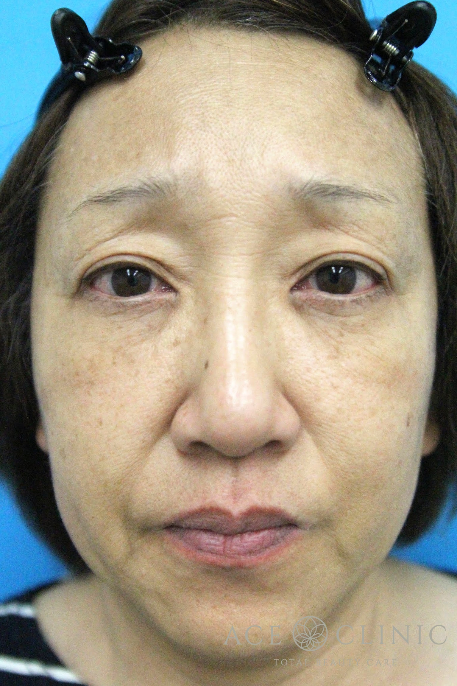 ヒアルロン酸リフト　施術前　正面