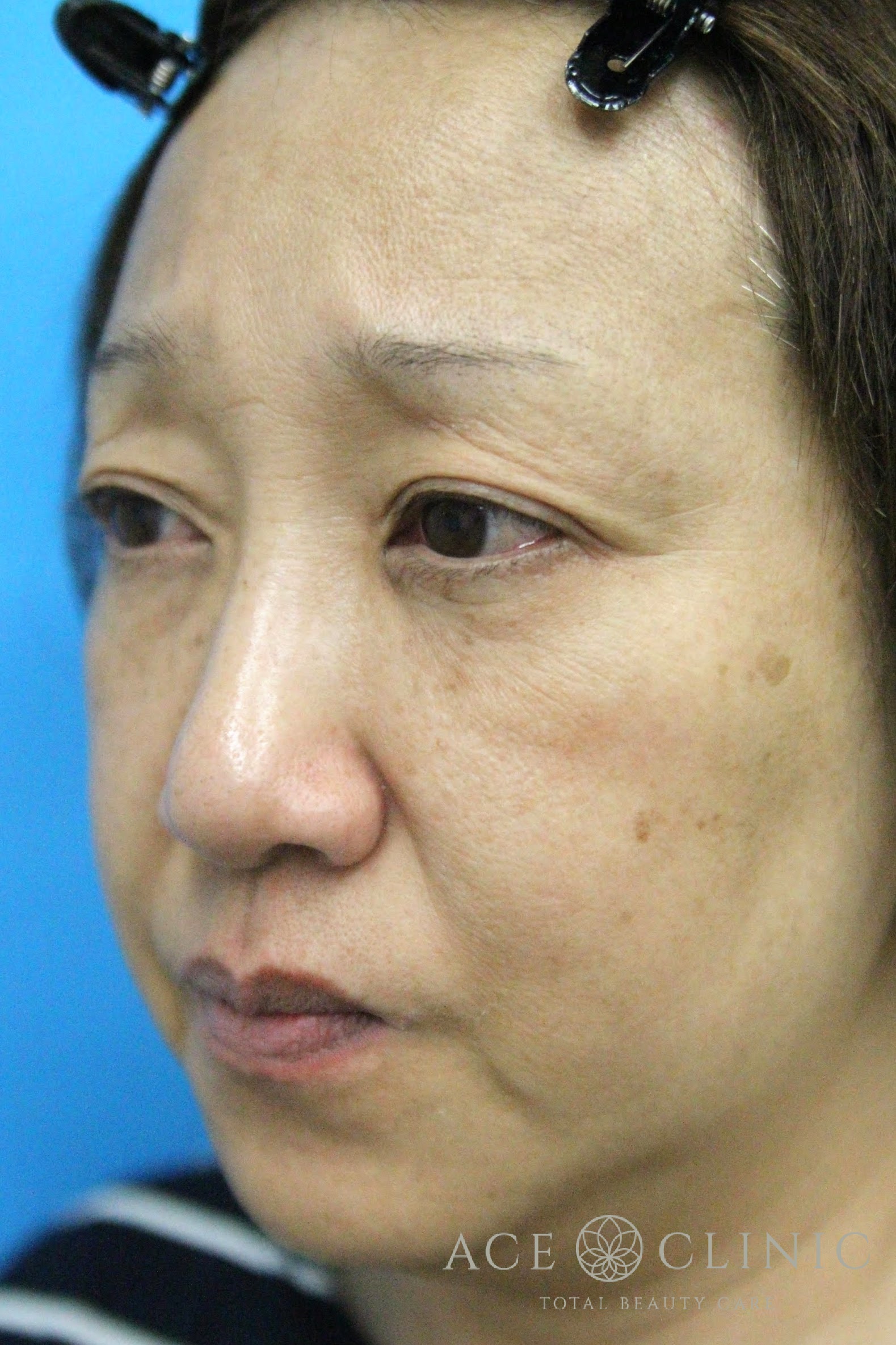 ヒアルロン酸リフト　施術前　左斜め