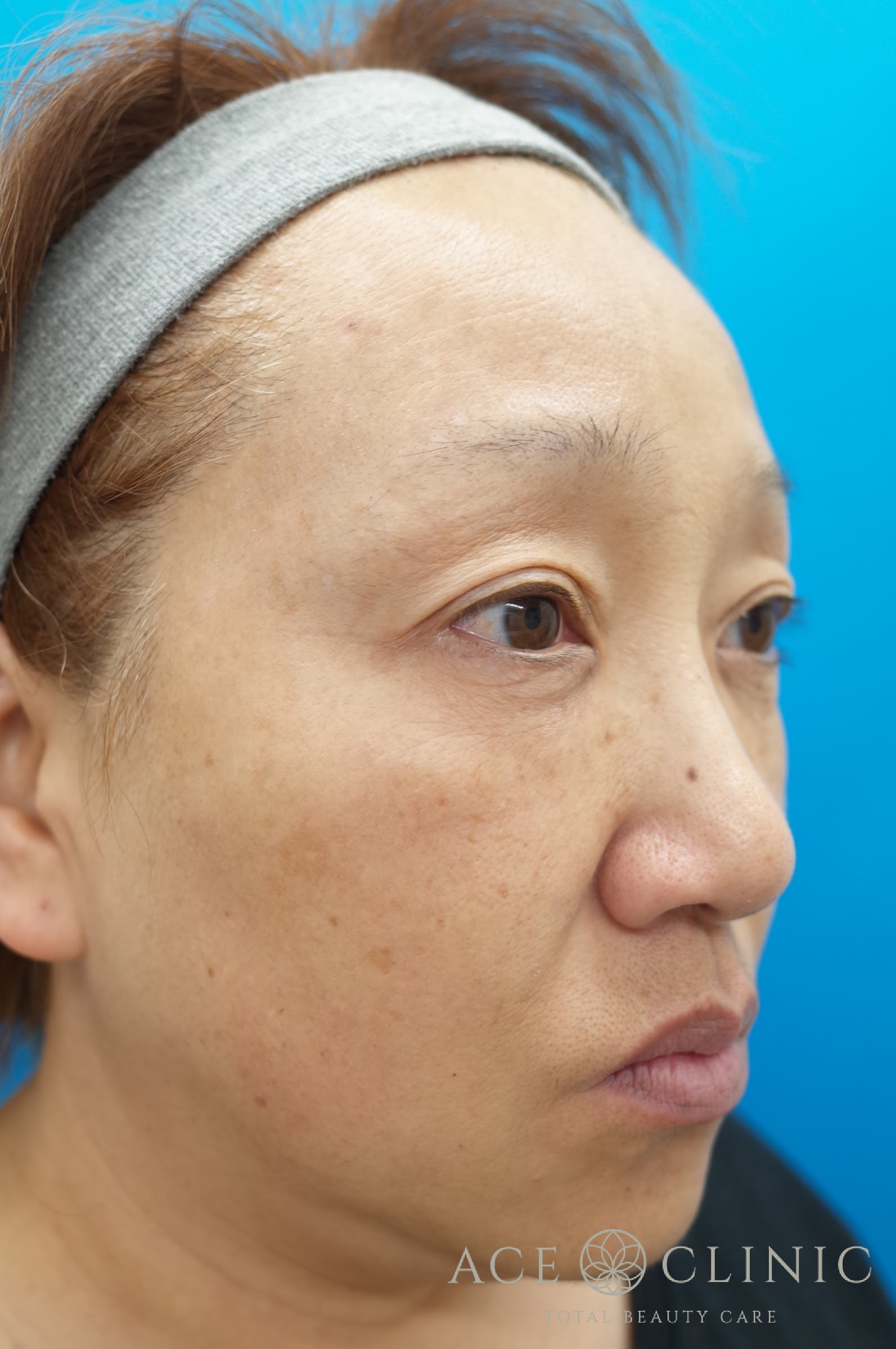 ヒアルロン酸リフト　施術後　右斜め