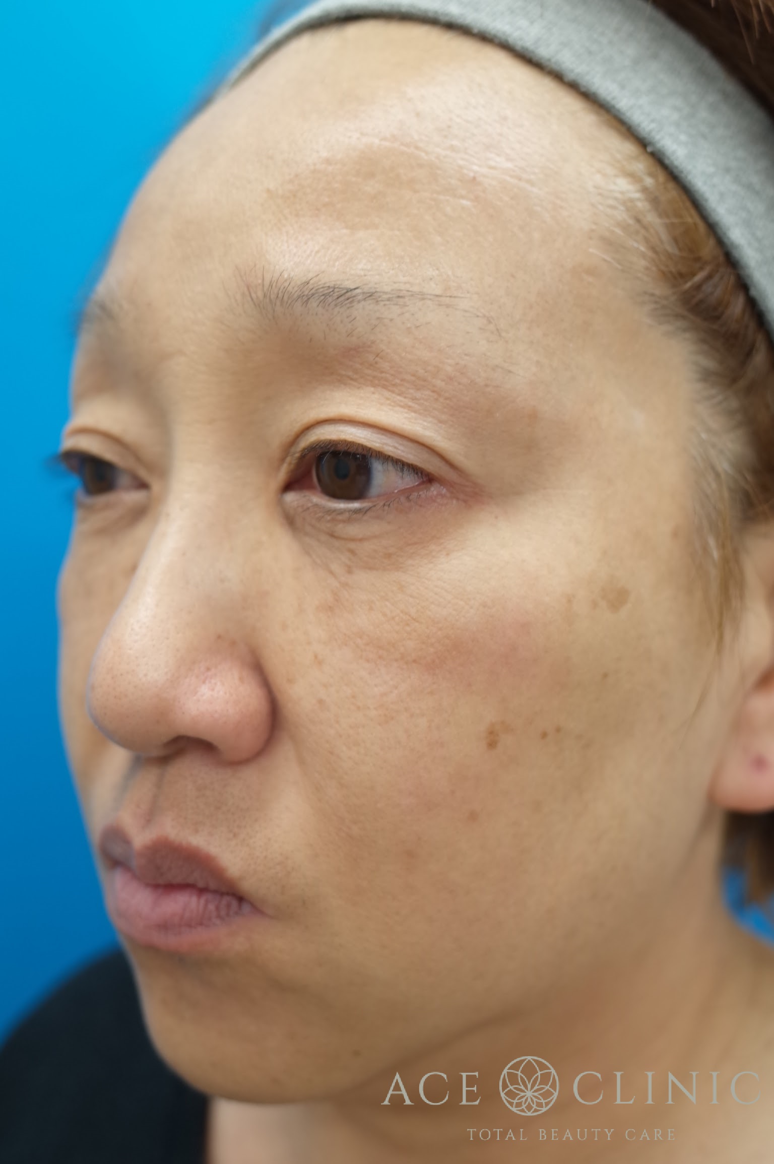 ヒアルロン酸リフト　施術後　左斜め