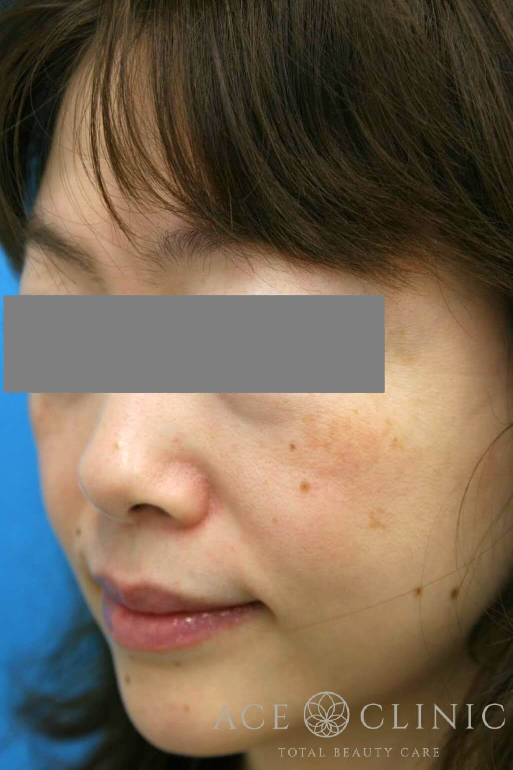 サーマクールCPT 施術前 左斜め