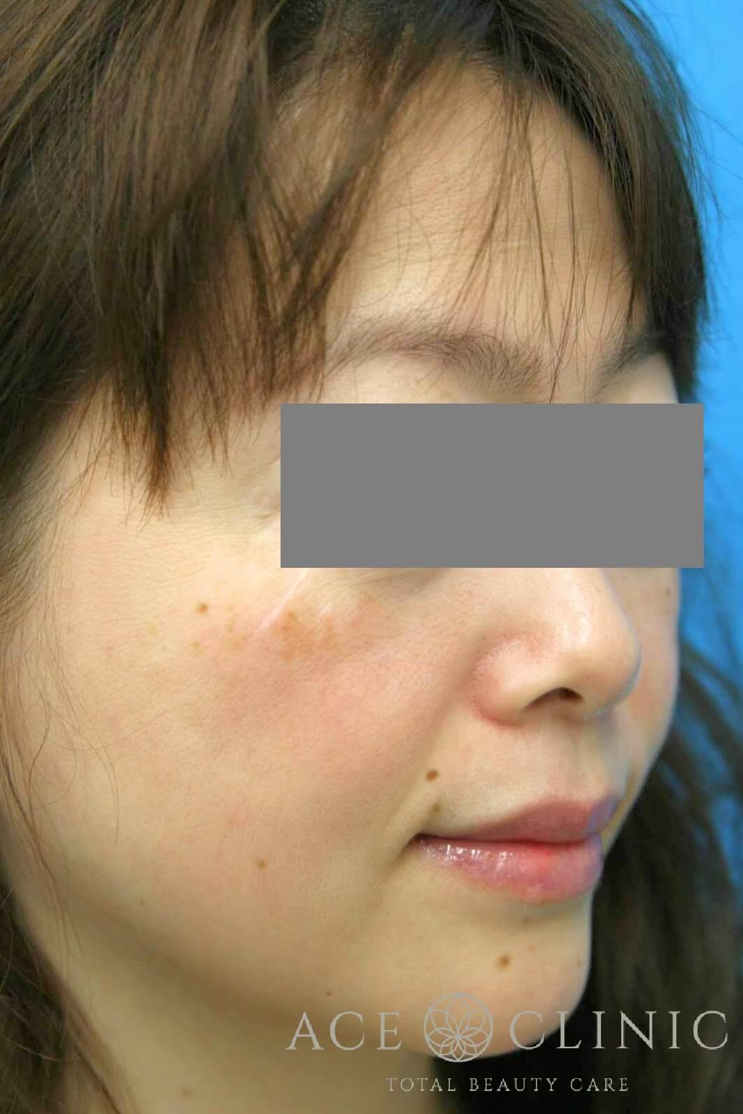 サーマクールCPT 施術前 右斜め