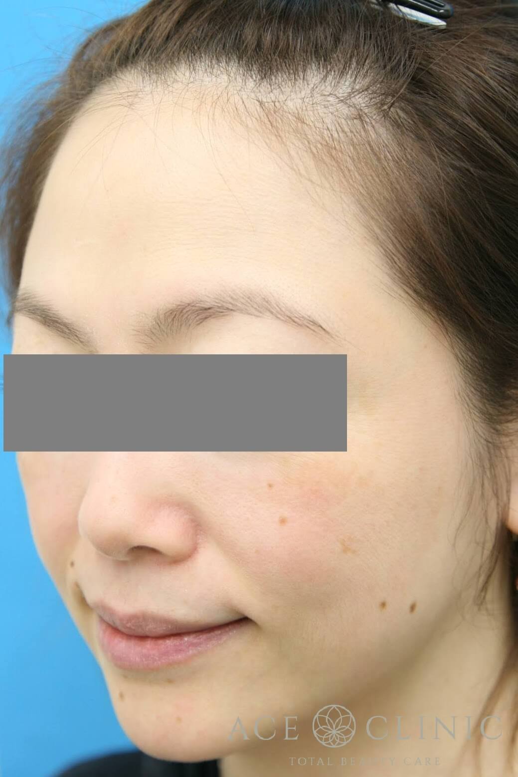 サーマクールCPT 施術後 左斜め