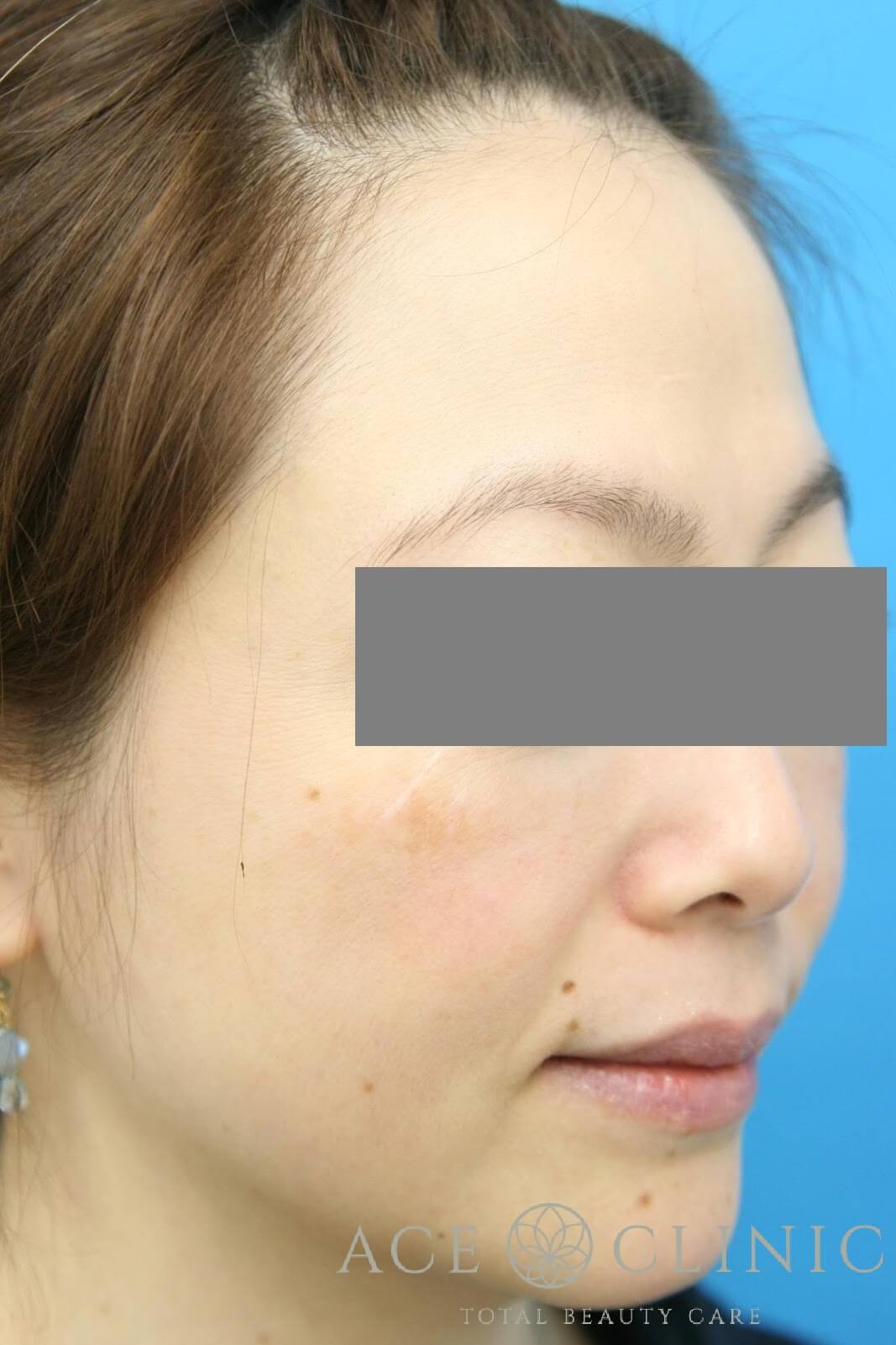 サーマクールCPT 施術後 右斜め