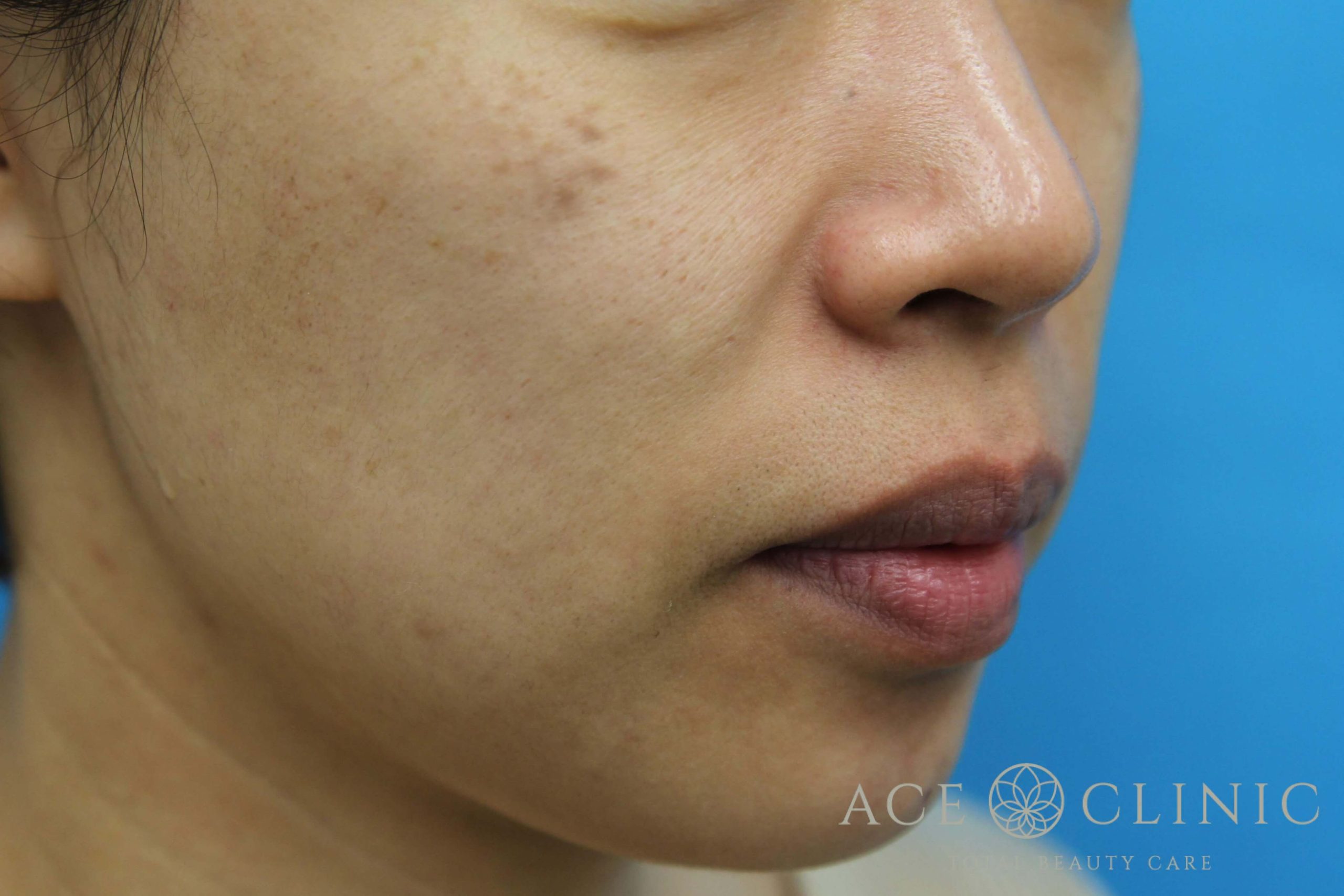 ADM　ピコレーザー治療　施術前　右斜め