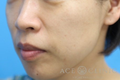 ADM　ピコレーザー治療　施術後　左斜め