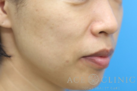 ADM　ピコレーザー治療　施術後　右斜め