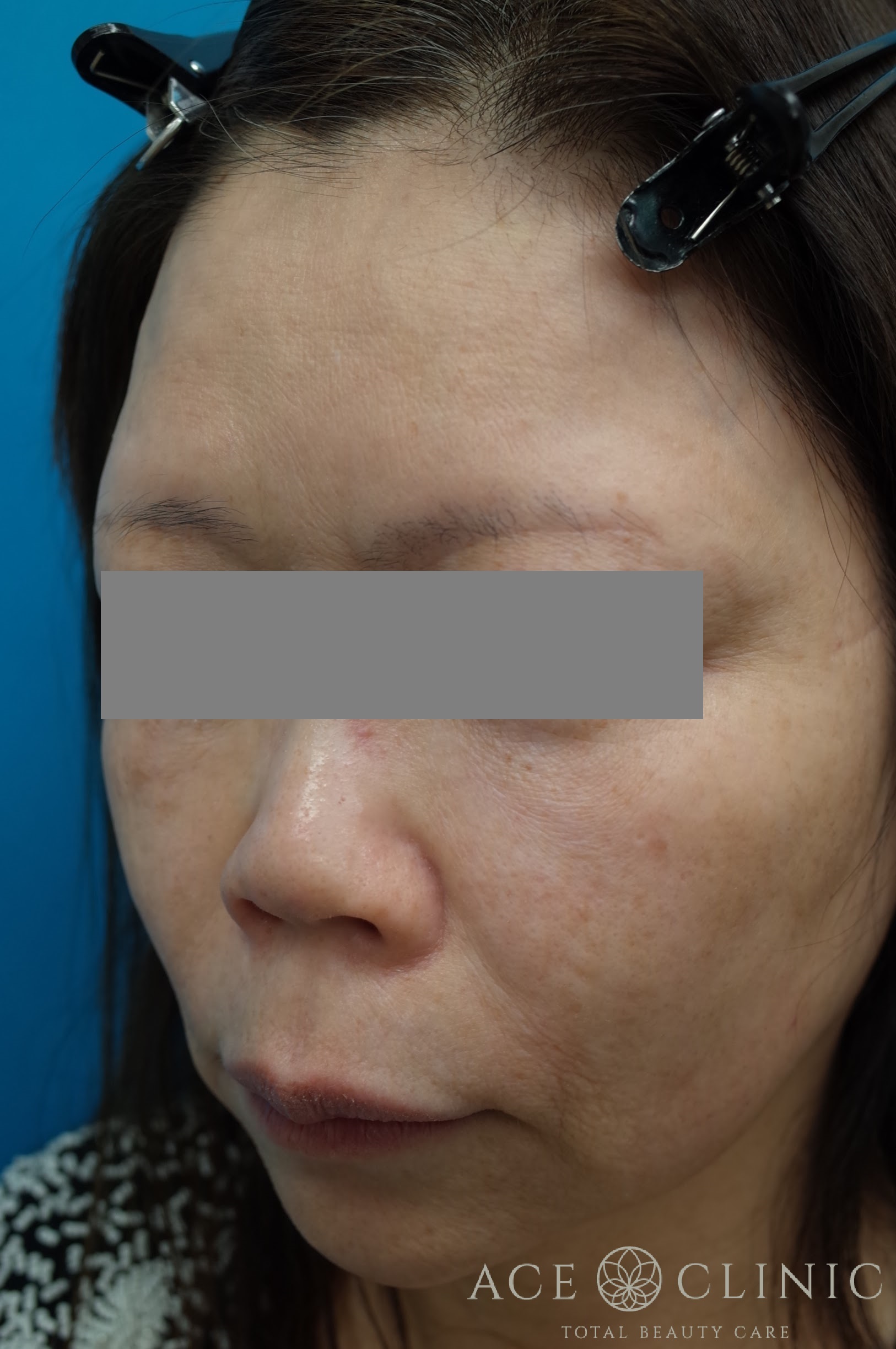 VOVリフトプレミアム 施術前 左斜め