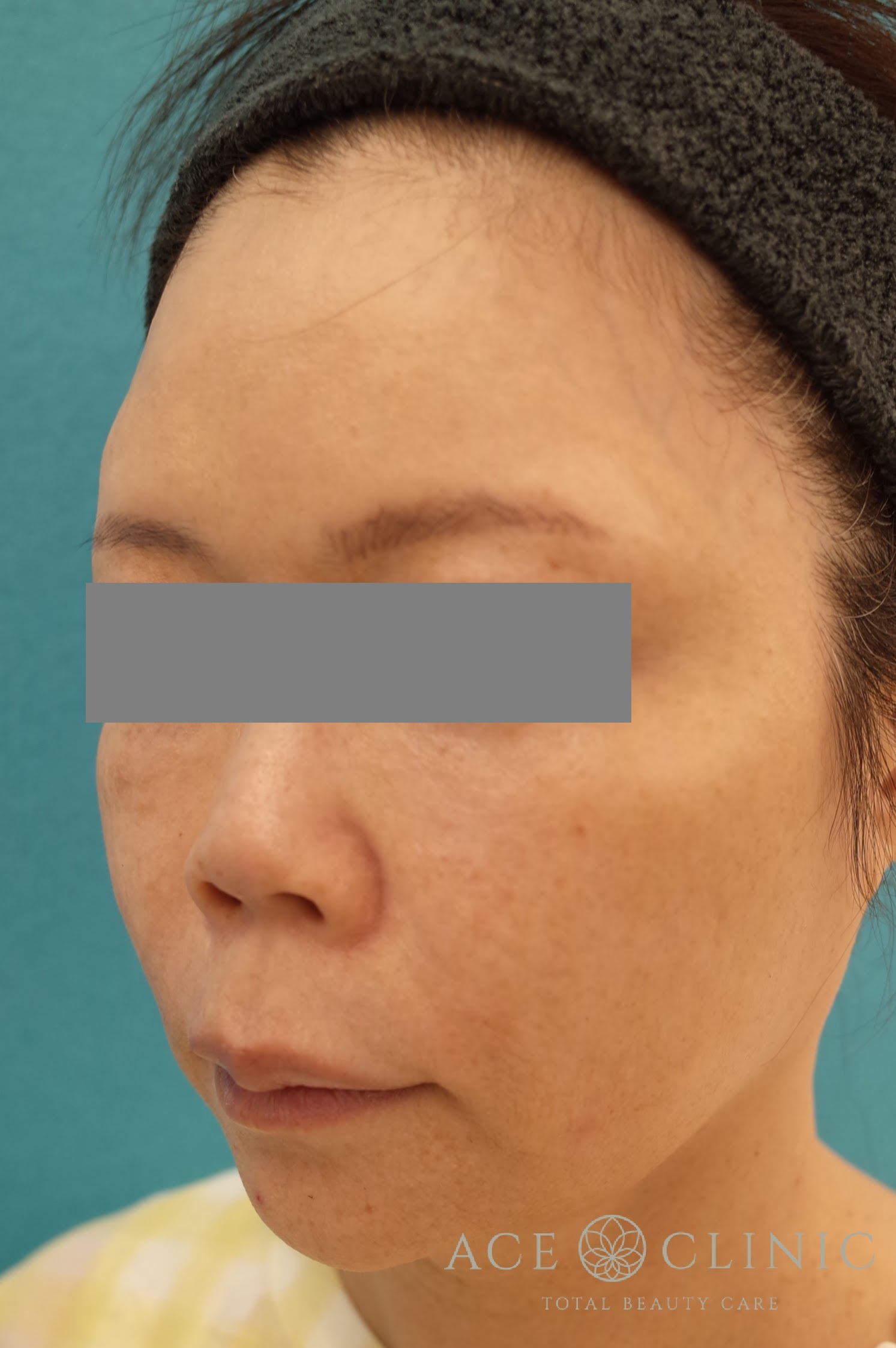 VOVリフトプレミアム 施術後 左斜め