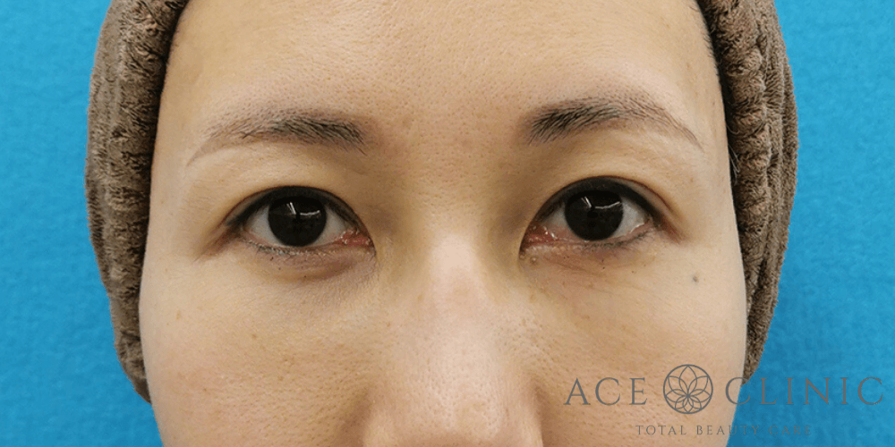 二重瞼スーパープレミアム埋没法_【エースクリニック】名古屋院・大阪梅田院