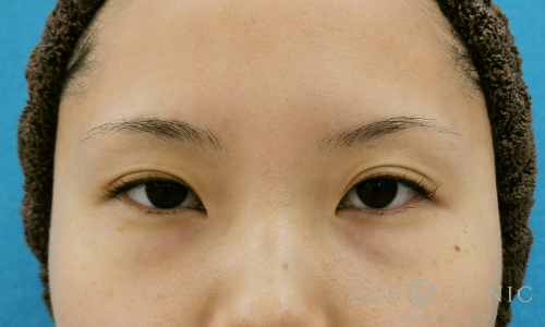 眼瞼挙筋前転術before