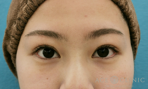 眼瞼挙筋前転術after