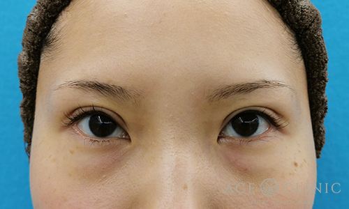 眼瞼挙筋前転術after