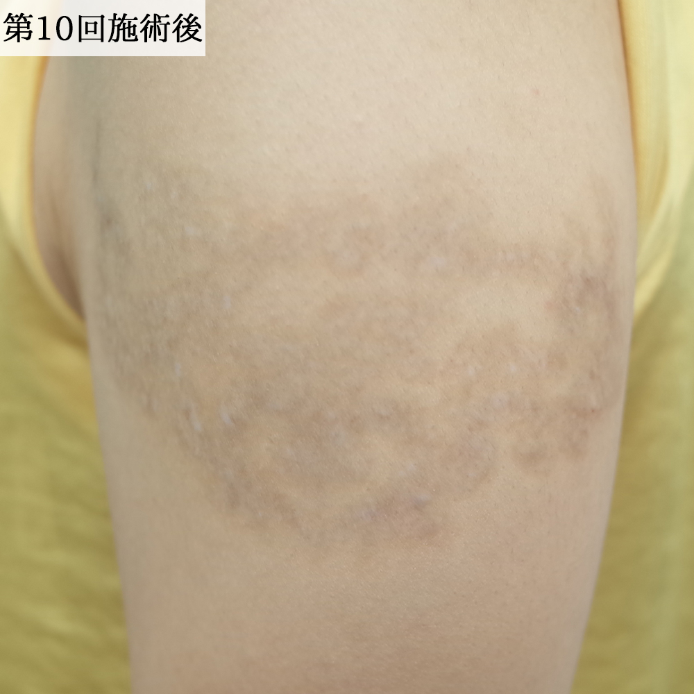 名古屋院_タトゥー除去レーザー治療【エースクリニック】