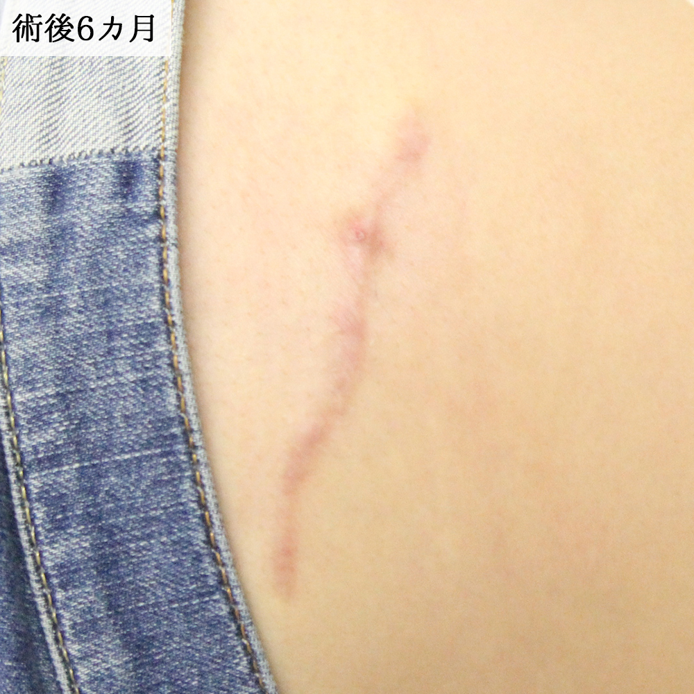 名古屋院_タトゥー除去切開法症例【エースクリニック】