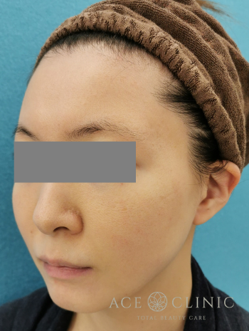 VOVリフトleft_1M後