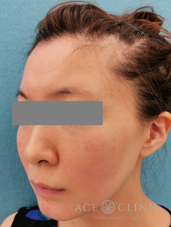 VOVリフト_before左