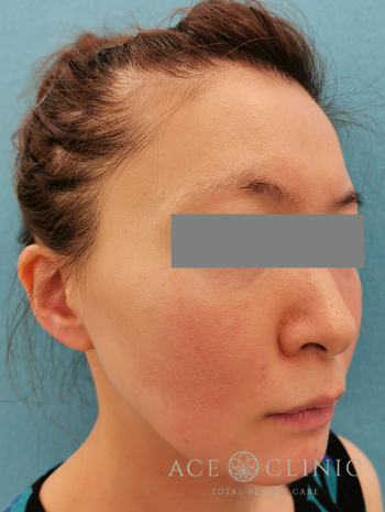 VOVリフト_before右