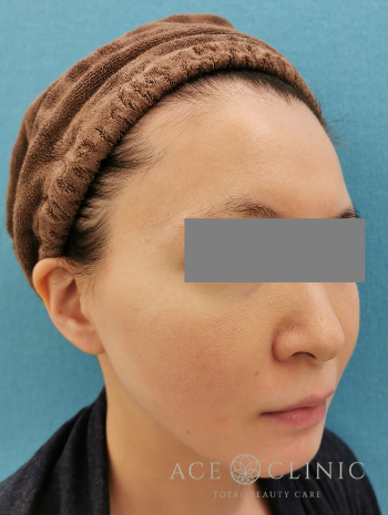 VOVリフトright_1M後