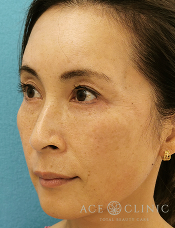 ヒアルロン酸・ボトックス症例