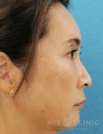 ウルセラ・サーマクール