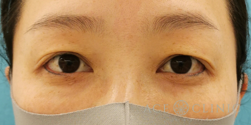 眼瞼下垂・眉毛下切開法-名古屋・大阪梅田エースクリニック