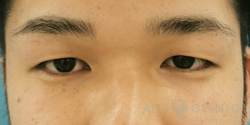 眼瞼下垂_before