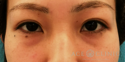 クマ治療_経結膜ハムラ法【エースクリニック】名古屋院・大阪梅田院