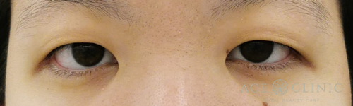 眼瞼下垂_眼瞼挙筋前転法-【エースクリニック】名古屋院・大阪梅田院