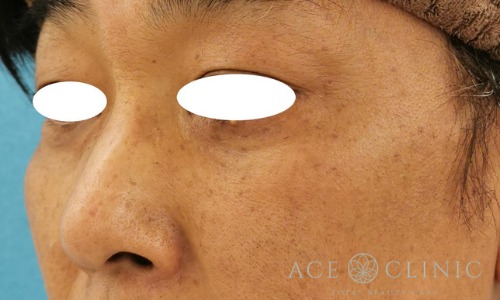 隆鼻術_プロテーゼ,軟骨移植