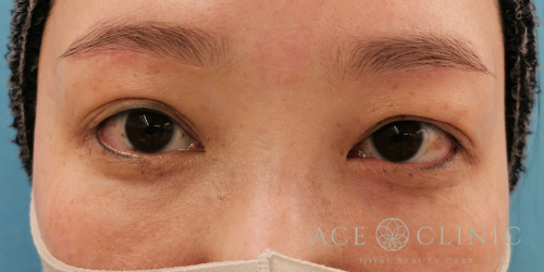 眼瞼下垂・眉毛下切開法-名古屋・大阪梅田エースクリニック