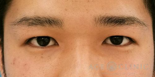 眼瞼下垂_after