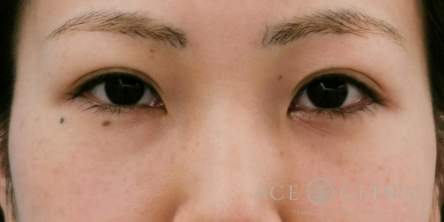 クマ治療_経結膜ハムラ法【エースクリニック】名古屋院・大阪梅田院