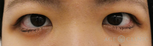 眼瞼下垂_眼瞼挙筋前転法-【エースクリニック】名古屋院・大阪梅田院