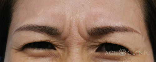 眉間ボトックス注射-【エースクリニック】名古屋院・大阪梅田院