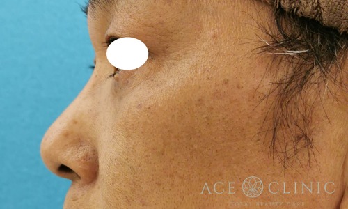 隆鼻術_プロテーゼ,軟骨移植