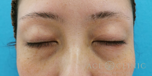 二重まぶた部分切開法　術前閉瞼時　【エースクリニック】名古屋院・大阪梅田院