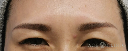 眉間ボトックス注射-【エースクリニック】名古屋院・大阪梅田院