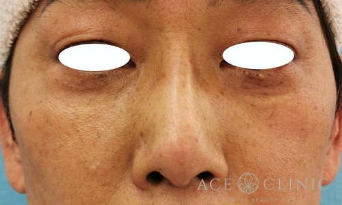 隆鼻術_プロテーゼ,軟骨移植