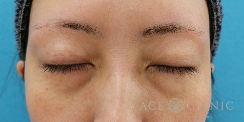 二重まぶた部分切開法　術後閉瞼時　【エースクリニック】名古屋院・大阪梅田院