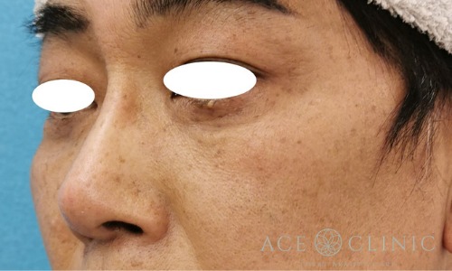 隆鼻術_プロテーゼ,軟骨移植