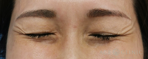 目尻ボトックス注射-【エースクリニック】名古屋院・大阪梅田院